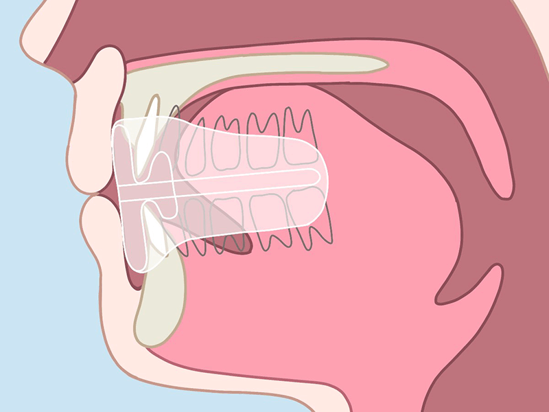 子供マウスピース矯正の治療プログラム中
