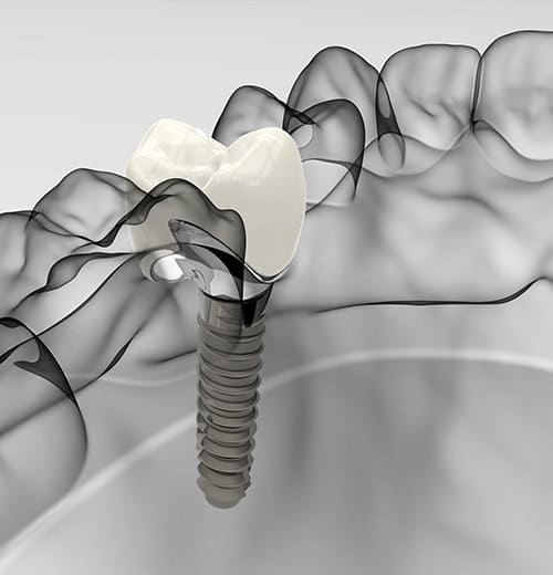 インプラント治療