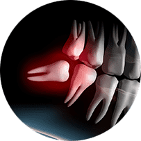 口腔外科・親知らず抜歯