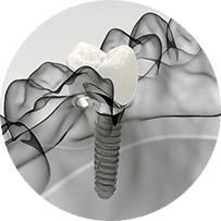 インプラント治療