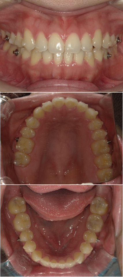 インビザライン(全顎マウスピース矯正)後