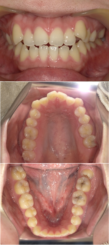 インビザライン(全顎マウスピース矯正)前