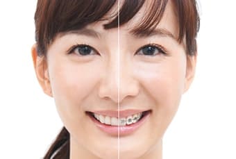 マウスピース矯正とは