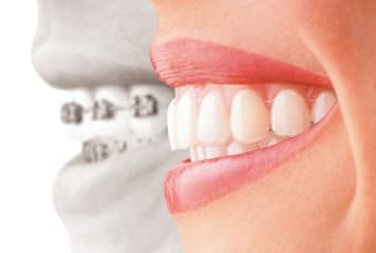 金属アレルギーも解消