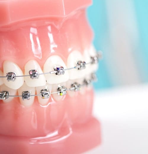 矯正歯科治療