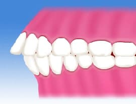 上顎前突（出っ歯）