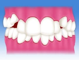 叢生（八重歯、乱ぐい歯）