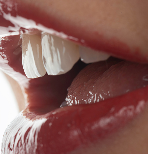 前歯の歯並びのマウスピース矯正