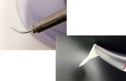 歯周ポケット内の洗浄