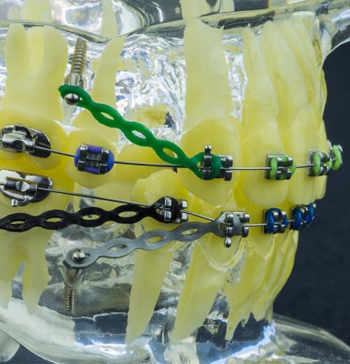 スピード矯正歯科治療