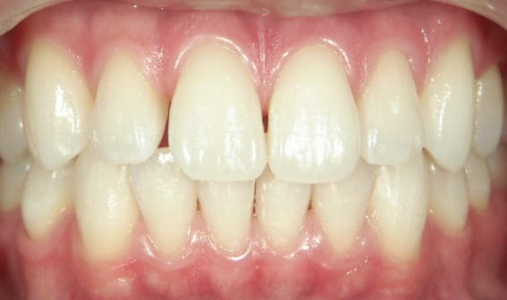 ホワイトニング後