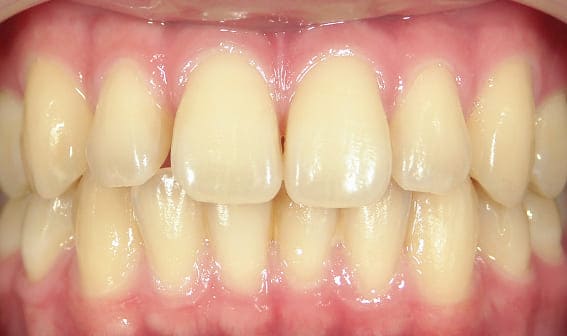 ホワイトニング前